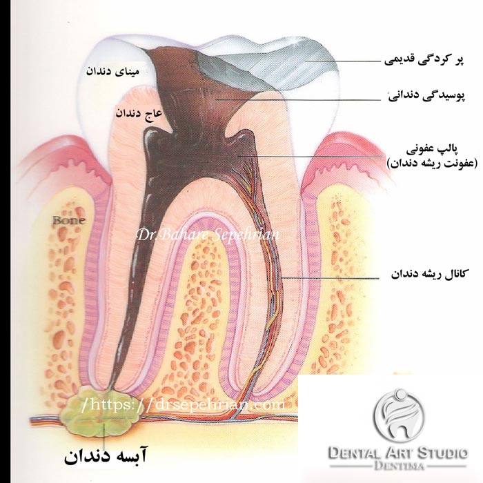 دلایل درد عصب دندان
