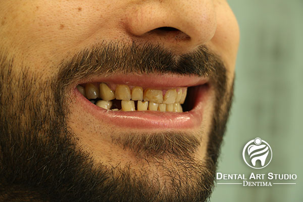 قبل از روکش تمام سرامیک دندان توسط دکتر سپهریان