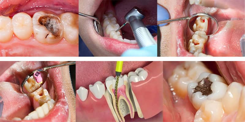 عصب کشی دندان یا درمان ریشه