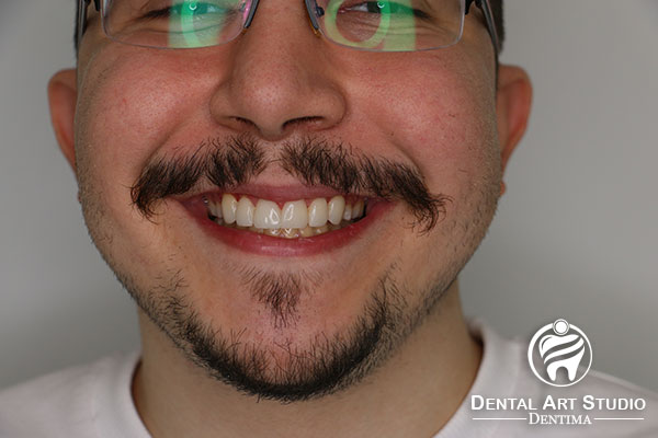نمونه درمان قبل از روکش تمام سرامیک دندان توسط دکتر سپهریان