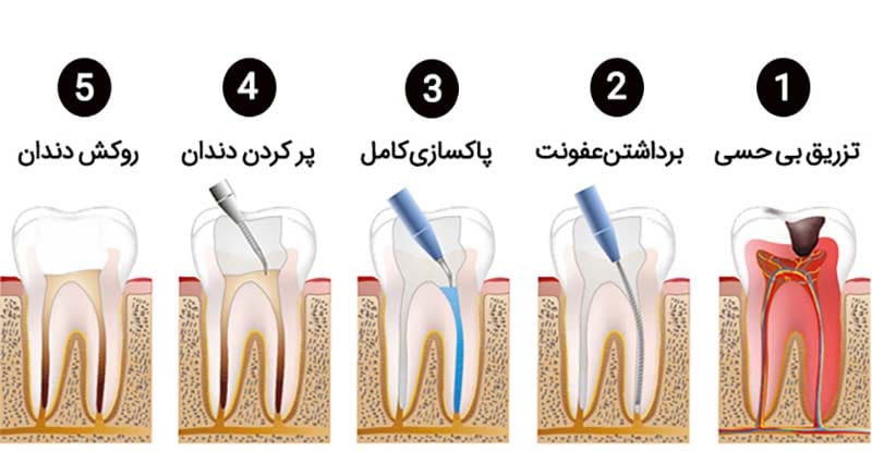 مراحل عصب کشی دندان کدامند؟