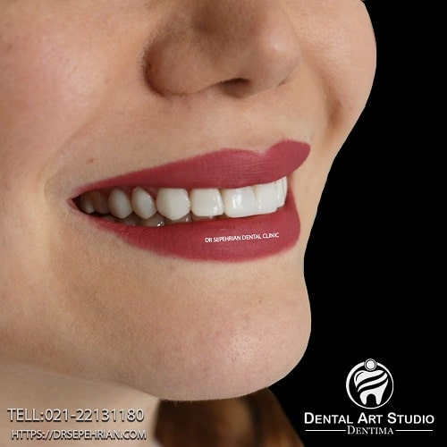 قبل و بعد از درمان کامپوزیت ونیر دندان توسط دکتر سپهریان