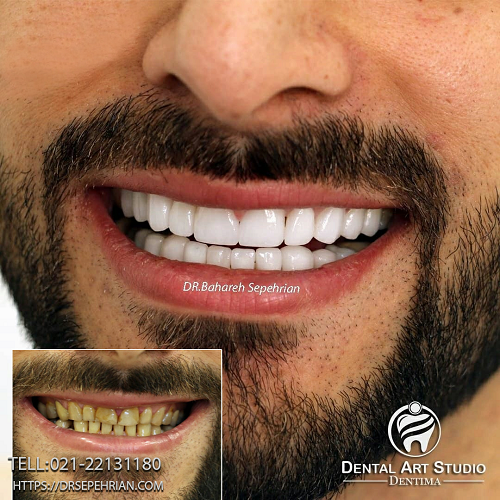 لبخند زیبا با کامپوزیت ونیر دندان توسط دکتر سپهریان