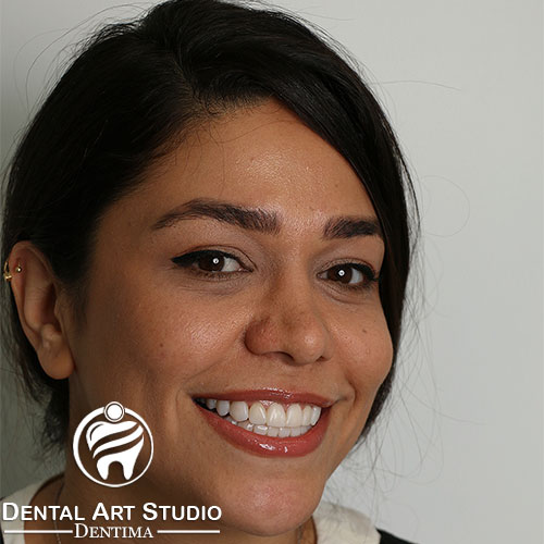 زیباسازی دندانها با کامپوزیت ونیر توسط دکتر سپهریان