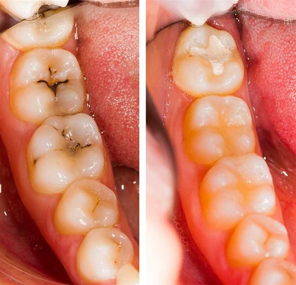 روش های مراقبت از دندان‌ های پر شده با کامپوزیت
