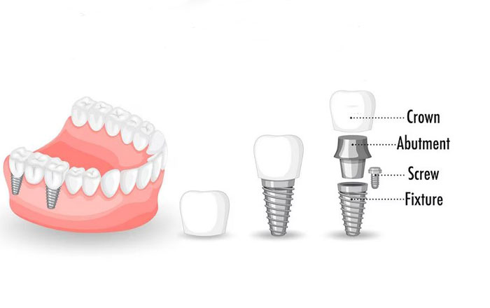 پروتز دندان و انواع آن 
