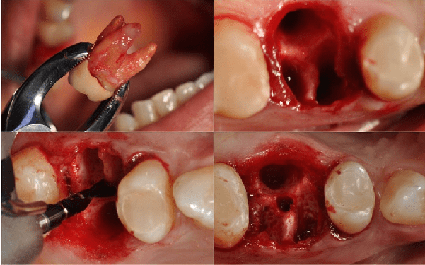 جلوگیری از خونریزی بعد از کشیدن دندان