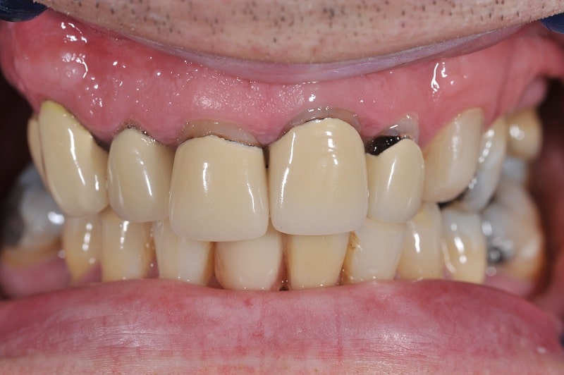 علت عفونت دندان روکش شده