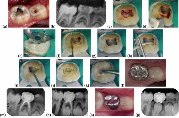 مراحل درمان عصب کشی دندان شیری