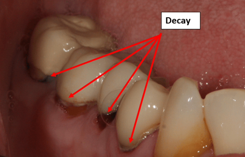 علائم عفونت دندان روکش شده