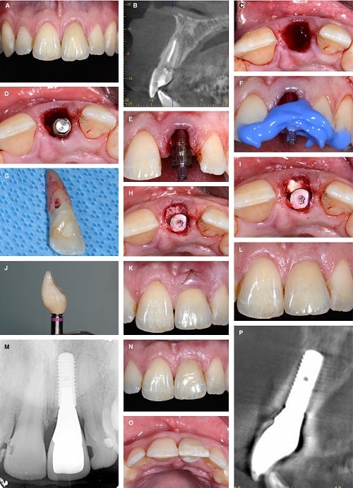 چه مدت بعد از کشیدن دندان می توان ایمپلنت کاشت؟