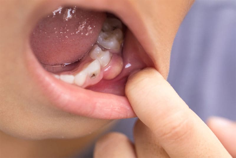 علائم آبسه دندان عصب کشی کدامند؟