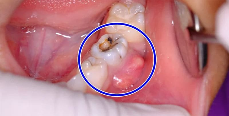 چرا باید آبسه دندان بعد از عصب کشی را سریع درمان کنیم؟