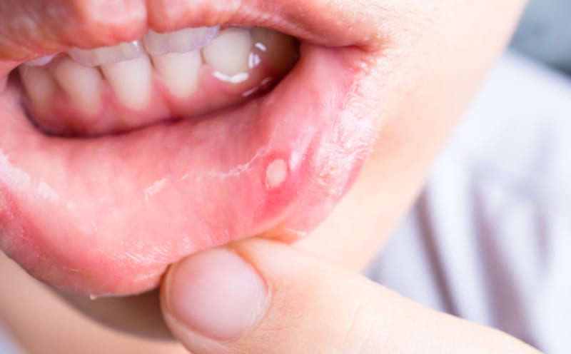 آفت دهان کودکان چه علائمی دارد؟