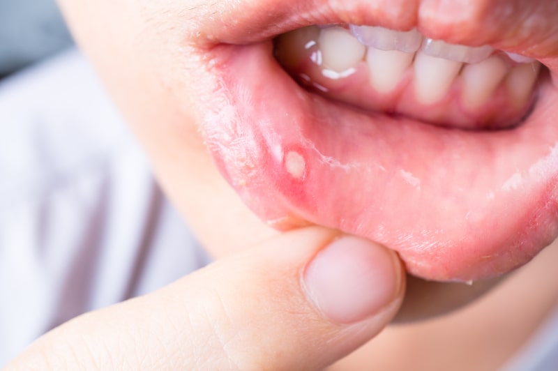 درمان آفت دهان چگونه است؟