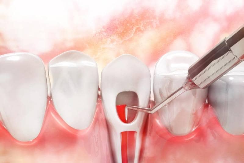 عصب کشی دندان روکش شده چگونه انجام می شود؟