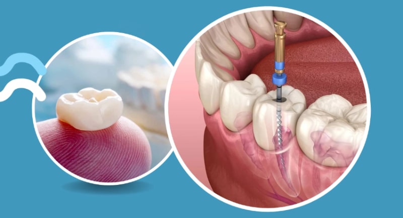 دلیل روکش کردن دندان بعد از عصب کشی چیست؟