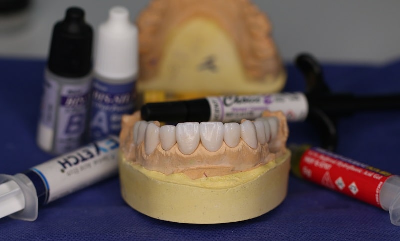 چسب دندان چیست و چه کاربردی دارد؟