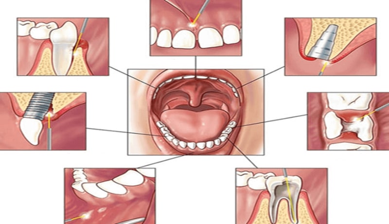 لیزر دندانپزشکی چه کاربردهایی دارد؟