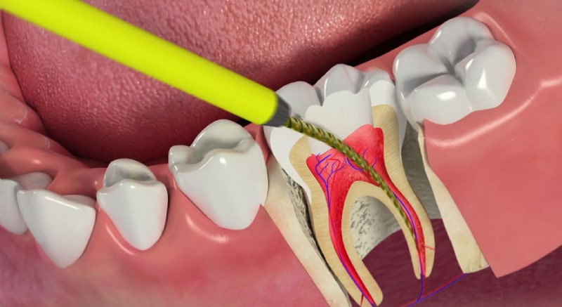 عصب کشی دندان لمینت شده چگونه انجام می شود؟