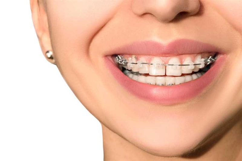 برای درمان فاصله بین دندان ها چه کنیم؟