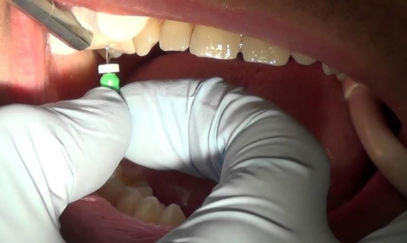 عصب کشی دندان برای انجام روکش