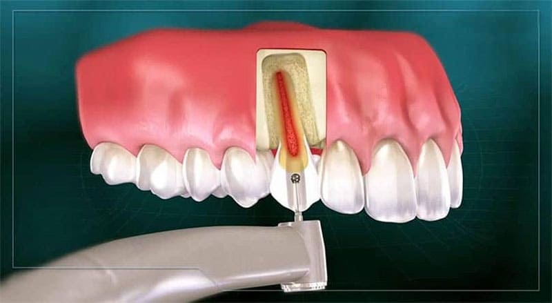 چه زمانی عصب کشی دندان قدامی بالا انجام می شود؟