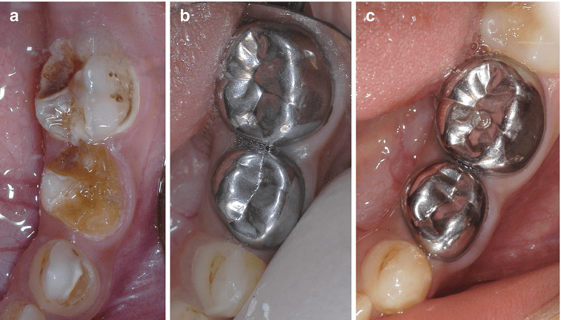 پالپوتومی یا عصب کشی دندان شیری چیست؟
