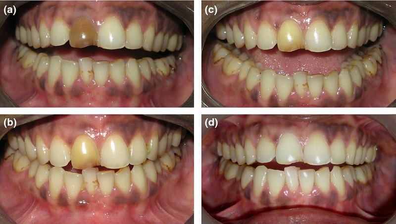 درمان تغییر رنگ دندان عصب کشی شده
