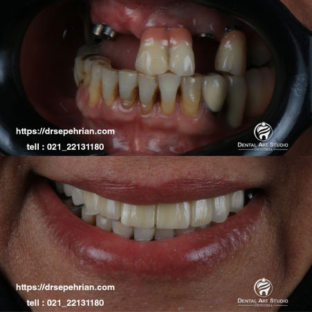 ایمپلنت دندان توسط دکتر سپهریان