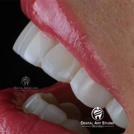 لمینت دندان توسط دکتر سپهریان