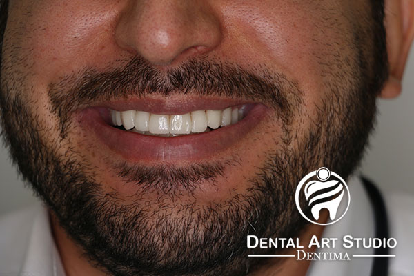 رفع نامرتبی دندانها بعد از انجام لمینت دندان