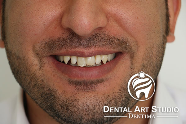 نامرتبی دندانها قبل از انجام لمینت دندان