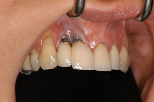 یکی از عوارض ایمپلنت دندان عفونت در محل قرارگیری 