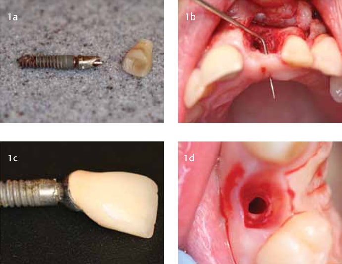 در صورت بروز عوارض ایمپلنت دندان چه کنیم؟