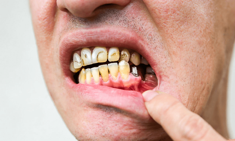 عوارض طولانی مدت ایمپلنت دندان