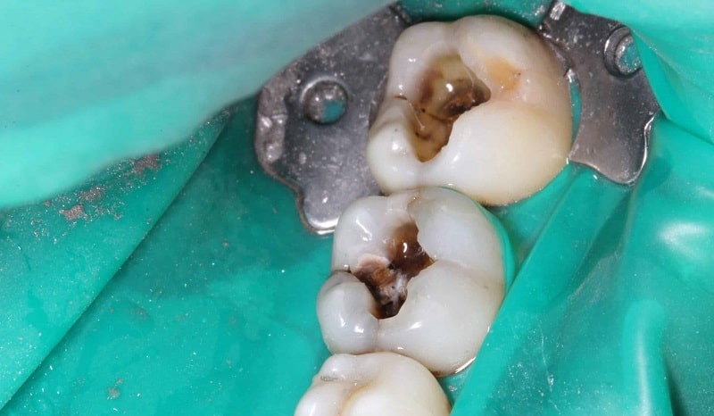 عوارض پر نکردن دندان بعد از عصب کشی
