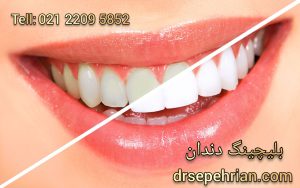 بلیچینگ دندان چیست | بلیچینگ دندان در تهران | دکتر سپهریان 
