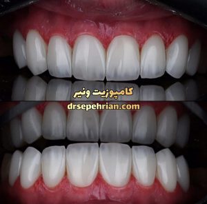 مراقبت های بعد از کامپوزیت ونیر | دکتر سپهریان