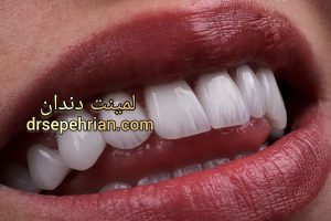 فرق کامپوزیت و لمینت چیست؟ | دکتر سپهریان