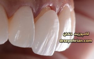 آیا کامپوزیت باعث پوسیدگی دندان میشود؟ | دکتر سپهریان
