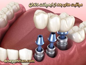مراقبت های بعد از ایمپلنت دندان | دکتر سپهریان