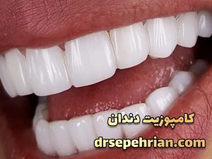 قیمت کامپوزیت دندان در سال 1403 | دکتر سپهریان